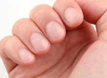 handsurgerypc_hand_care_nail_bed_injuries